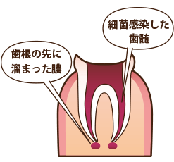 イラスト：1 歯根の先に溜まった膿と細菌感染した歯髄