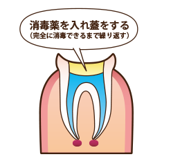 イラスト：3 消毒薬を入れ蓋をする(完全に消毒できるまで繰り返す)