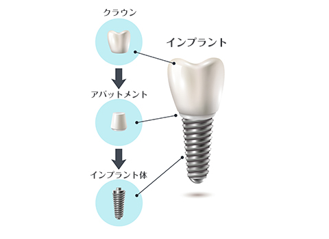 イラスト：インプラントの構造