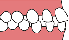 イラスト：すきっ歯