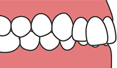 イラスト：過蓋咬合